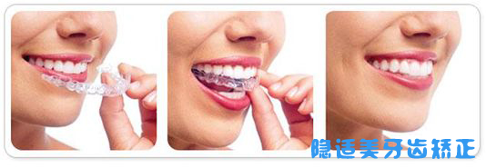 上海雅悦口腔门诊有限公司隐适美牙齿矫正